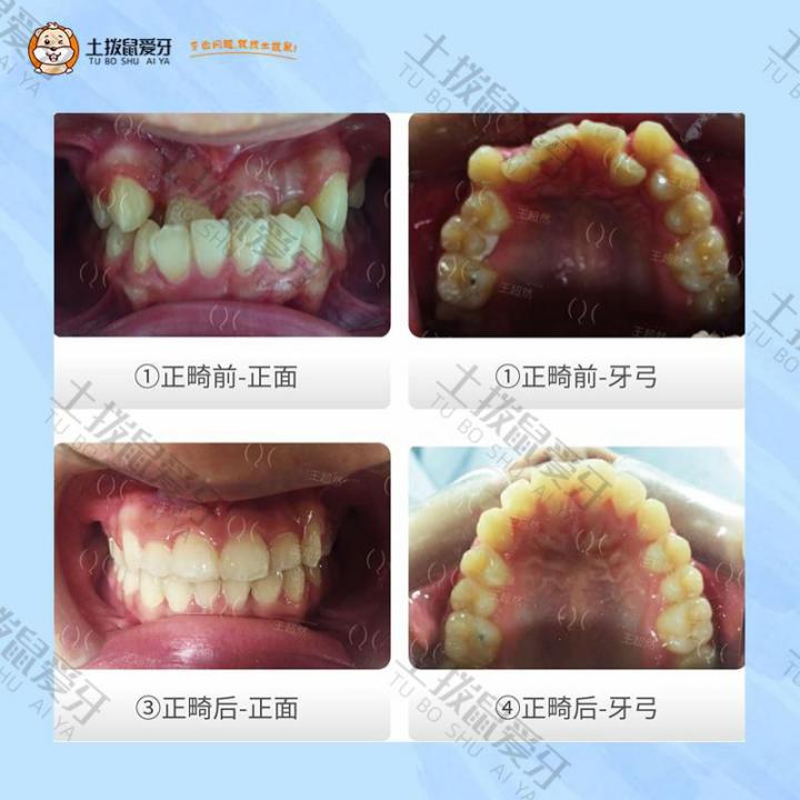 地包天，牙齿拥挤不齐矫正案例
