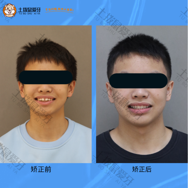 青少年牙齿龅牙矫正案例