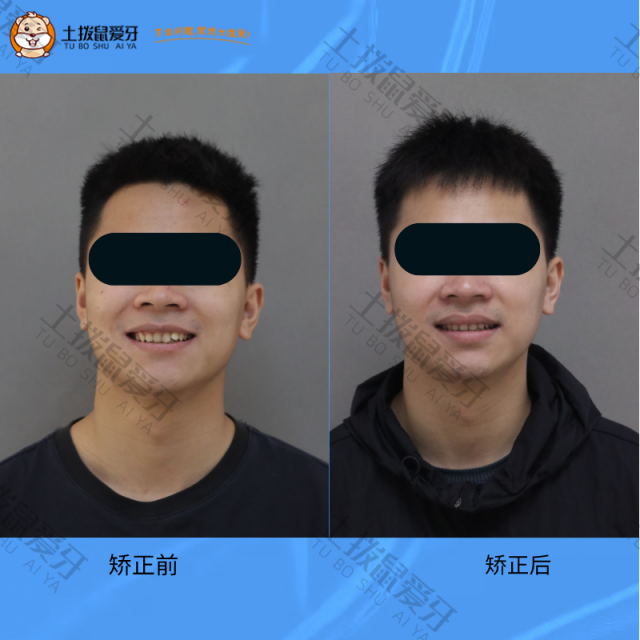门牙内凹矫正案例
