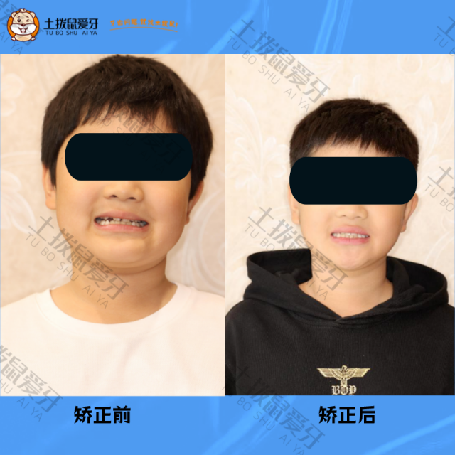 儿童右侧全牙弓反合矫正案例