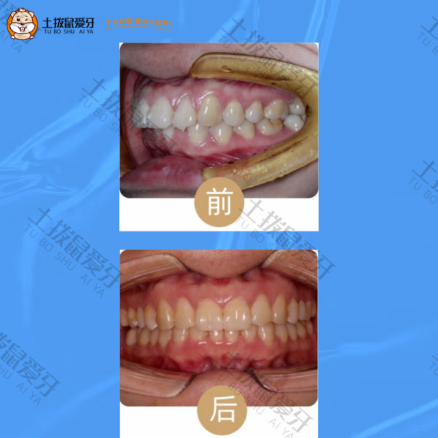 牙齿外凸矫正案例
