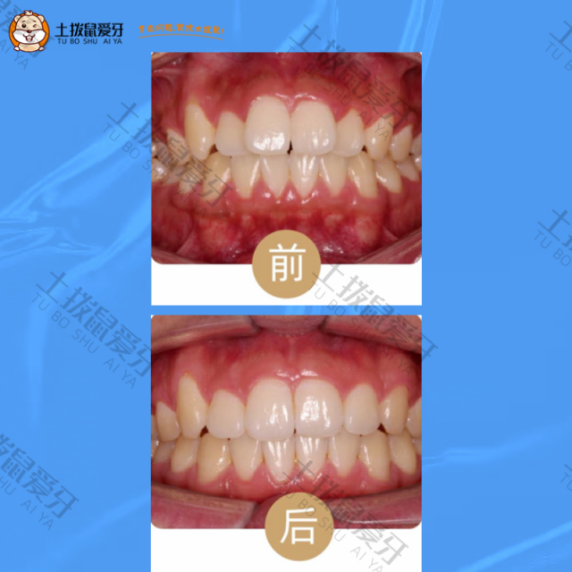 牙齿拥挤，微凸矫正案例