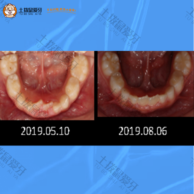 门牙内陷牙齿矫正案例