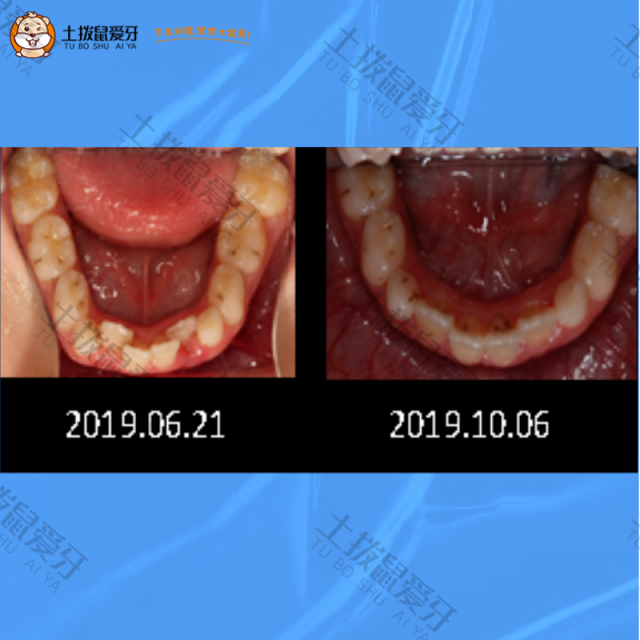 牙齿拥挤+不齐矫正案例