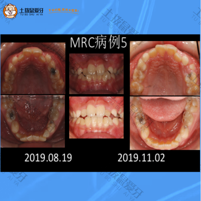 儿童牙齿拥挤不齐矫正案例