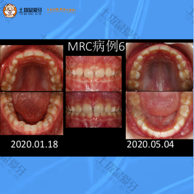 儿童牙齿拥挤不齐+深覆合矫正案例