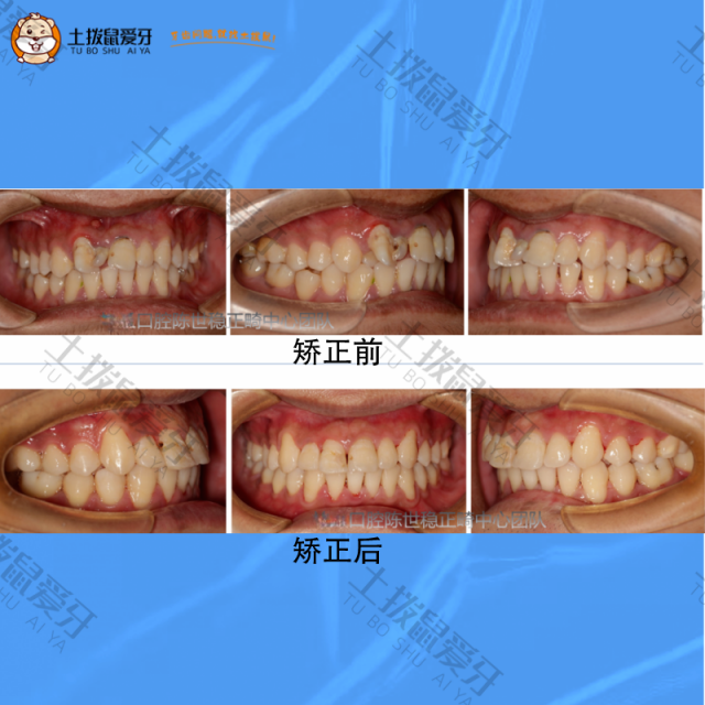 牙齿不齐固定矫治案例