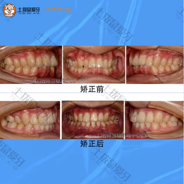 牙齿不齐+深覆合，牙齿矫正案例