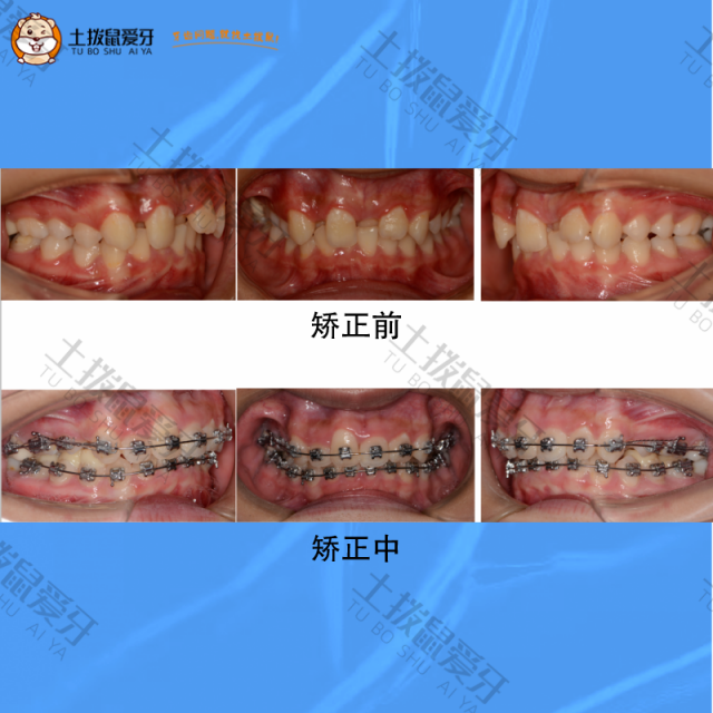 牙齿不整齐+个别牙齿反合，金属矫正案例