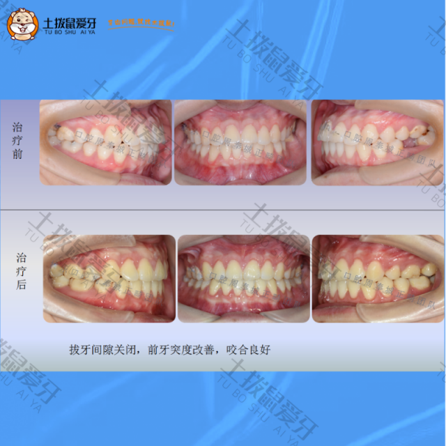28岁，嘴突，左下大牙缺失5年，牙齿矫正案例
