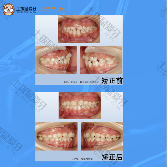 8岁地包天牙齿矫正案例