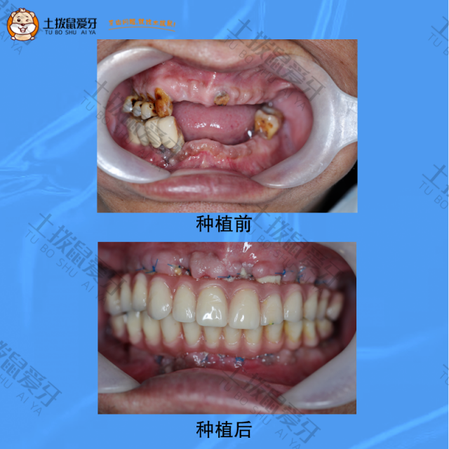 上下颌牙多颗牙齿缺失，牙齿种植案例