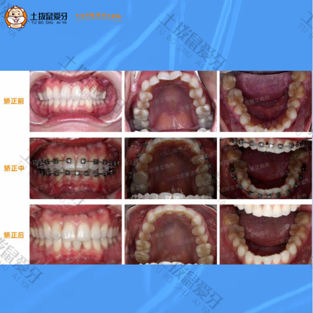 门牙倾斜伴随牙列不齐，金属自锁案例
