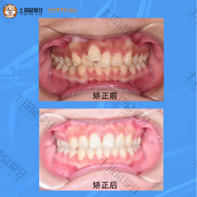 17岁门牙唇向错位，排列拥挤不齐矫正案例