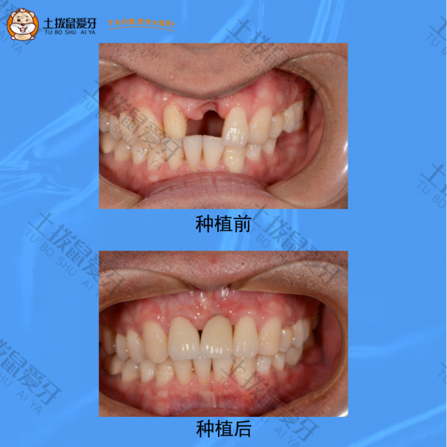 前牙牙齿即拔即种，种植案例