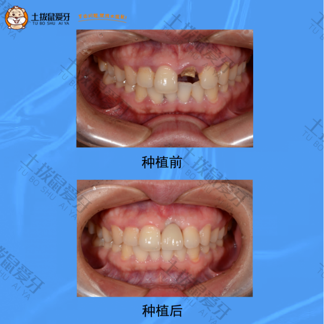 前牙即拔即种，种植案例