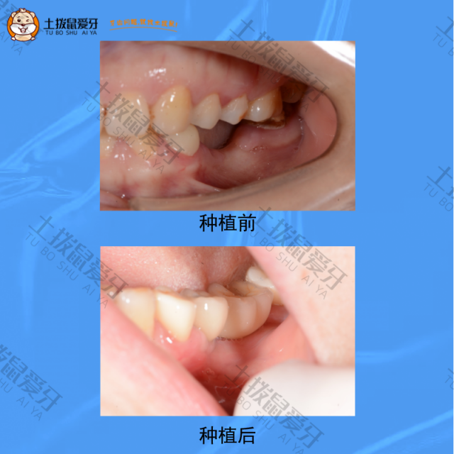 后槽牙齿缺失一颗，牙齿种植案例