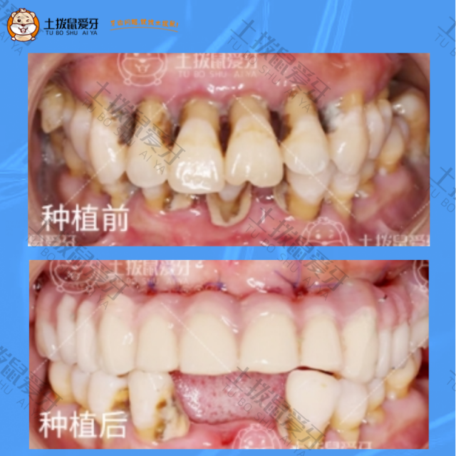 上下颌牙龈萎缩，松动，半口种植案例