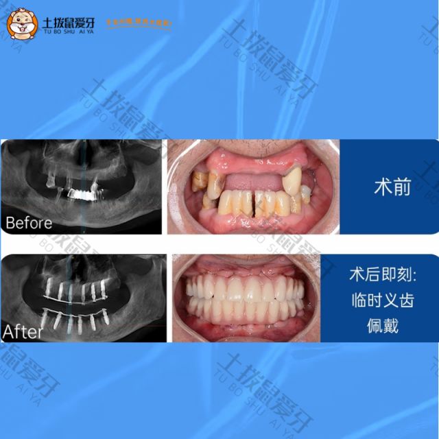 多颗牙齿缺失，全口即刻种植案例