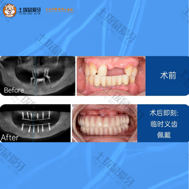 多颗牙齿缺失，即刻种植案例