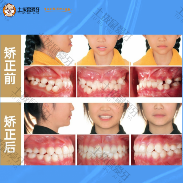 牙齿地包天+拥挤不齐，牙齿矫正案例