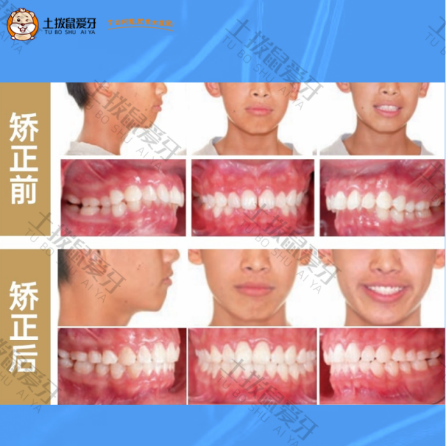 牙齿拥挤不齐加龅牙，牙齿矫正案例