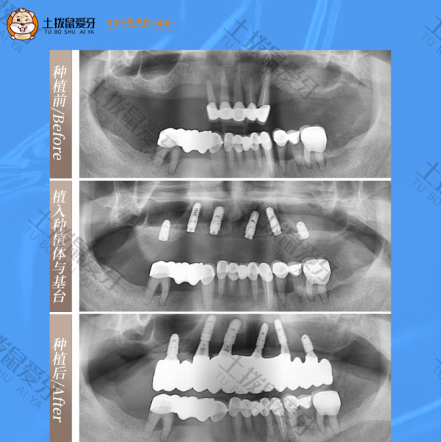 牙齿多颗缺失，牙齿半口种植案例
