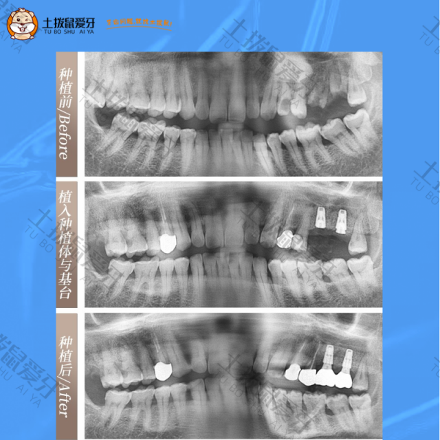 两颗牙齿缺失，种植案例