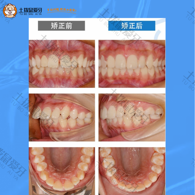 龅牙，牙齿矫正案例