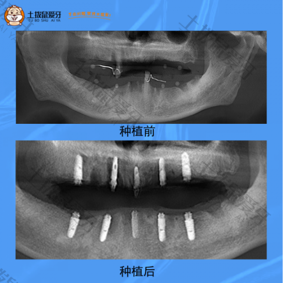 90岁，全口多颗牙残缺、缺失数年，牙齿种植案例