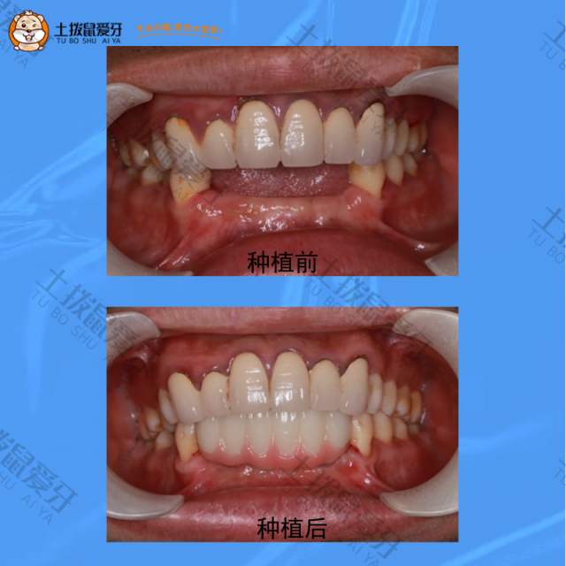 下颌前牙缺失6个月，牙齿种植案例