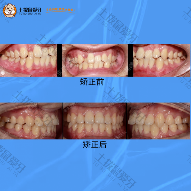 牙齿重度拥挤不整齐矫正案例