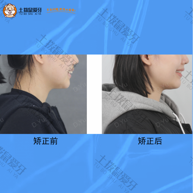 女士牙齿前突，矫正案例