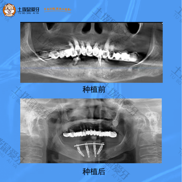 下颌牙齿多颗缺失，半口种植案例