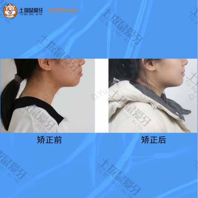 成人女士牙齿龅牙，矫正案例