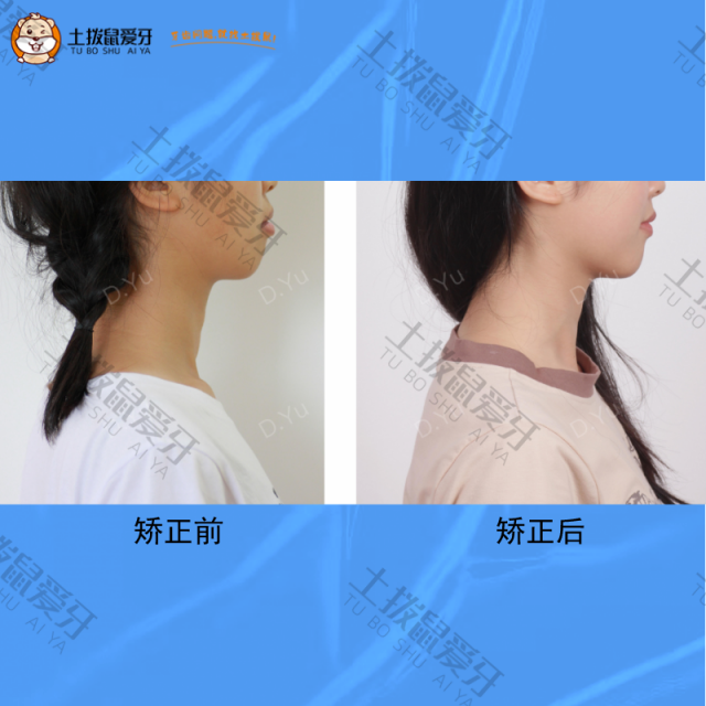 牙齿向前凸，矫正案例