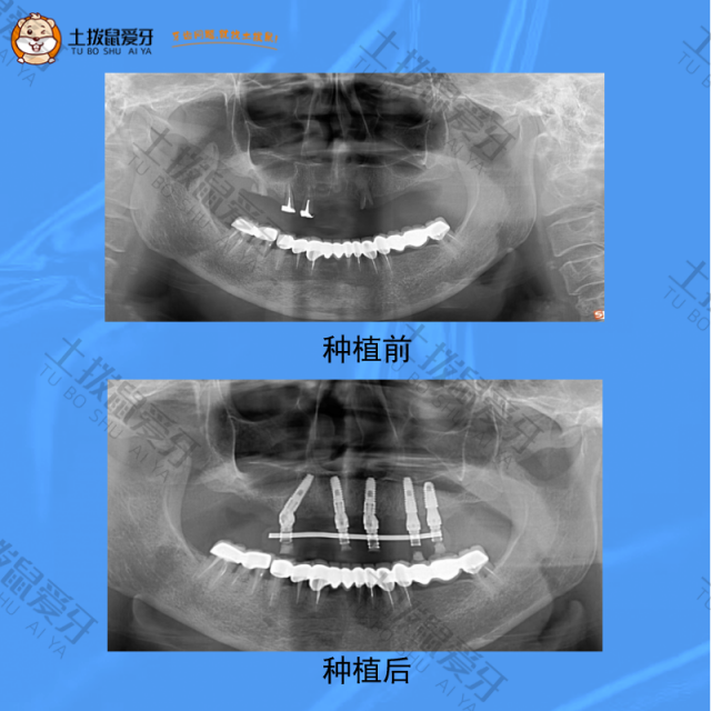 上牙缺失多颗，半口种植案例