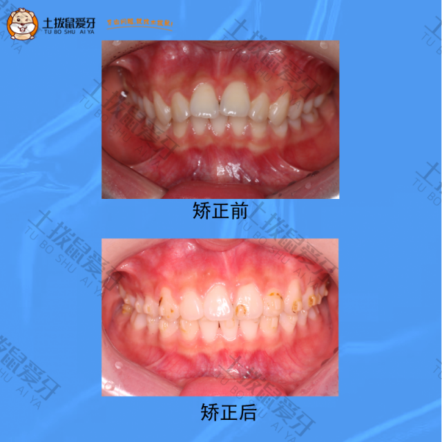 右侧磨牙偏远中关系，前牙深覆盖，右侧尖牙远中关系，右侧下颌缺少一颗侧切牙，矫正案例