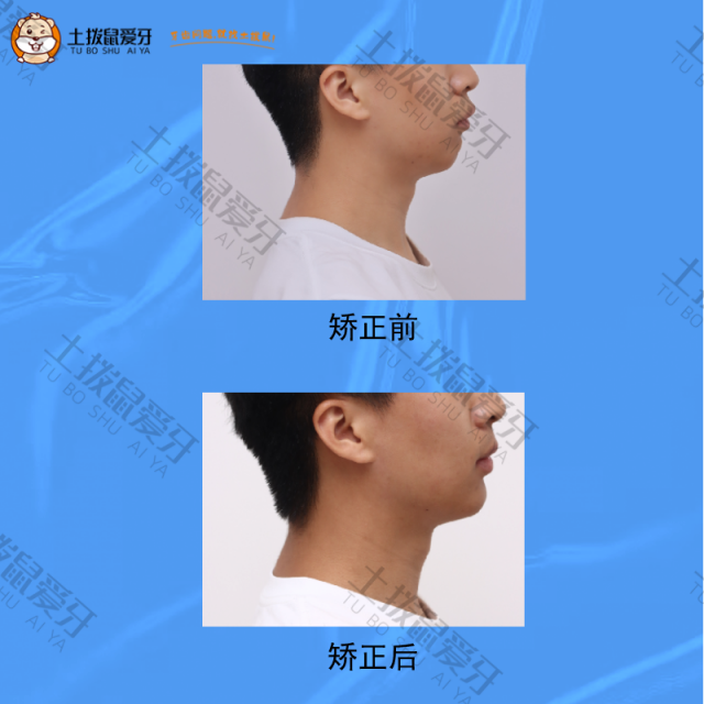 前牙深覆，III度深覆合，下牙列中度拥挤，骨性II类，下颌后缩，矫正案例