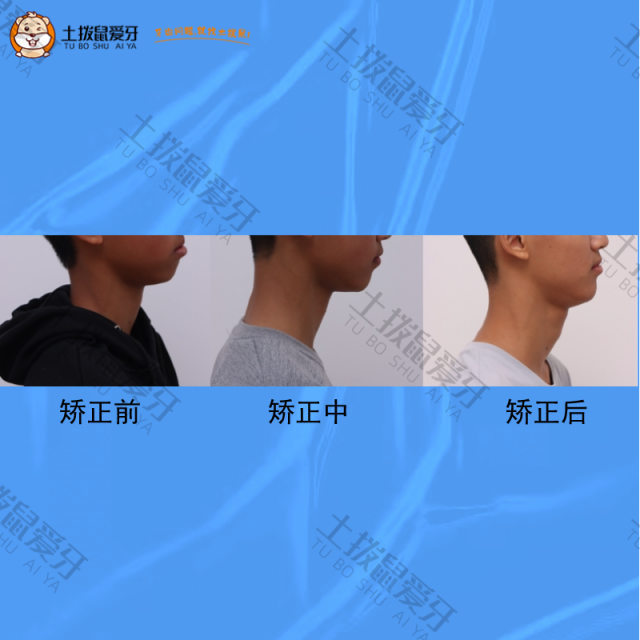 开唇露齿，凸面型，下颌后缩，牙齿矫正案例