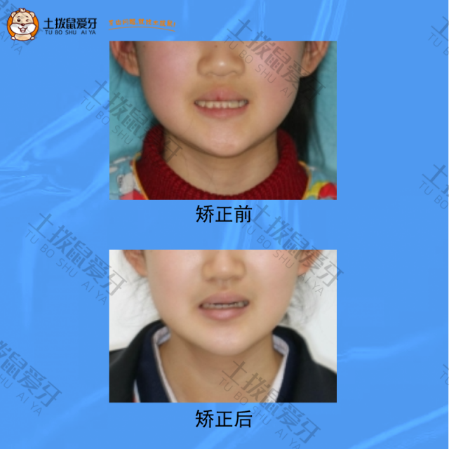 42 缺失，上下牙列拥挤不齐，深覆盖，牙齿矫正案例