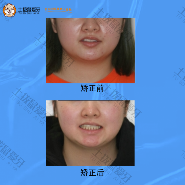 上颌前突，上下牙列拥挤不齐，下中线左偏，牙齿矫正案例