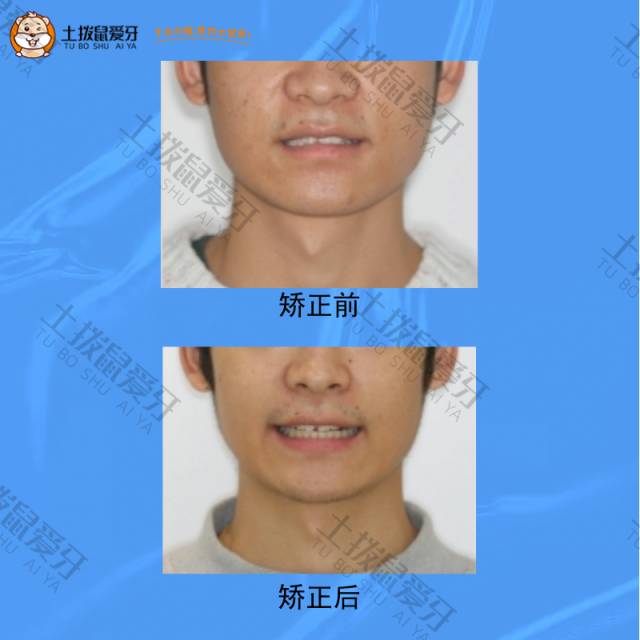 上下牙列拥挤不齐，右侧尖牙磨牙远中合、左侧尖牙磨牙中性合,牙齿矫正案例