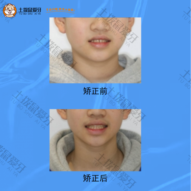 下颌前突，上下牙列拥挤不齐，前牙反覆合，牙齿矫正案例