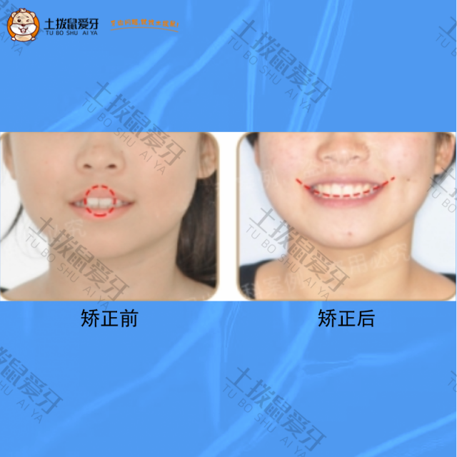 牙齿拥挤+前凸，牙齿矫正案例
