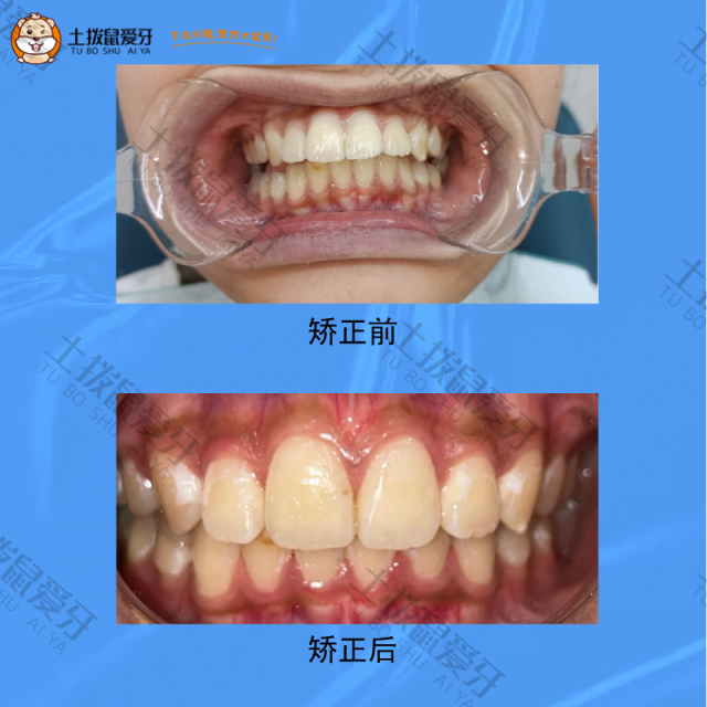 牙齿深覆盖+牙齿咬合不齐，牙齿矫正案例