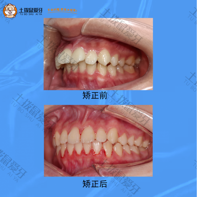 牙齿外凸+深覆盖，牙齿矫正案例