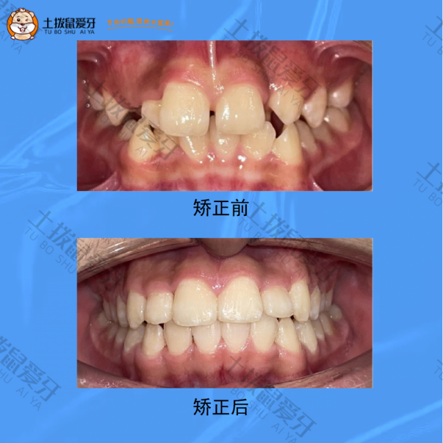 牙齿拥挤，错乱不齐，牙齿矫正案例