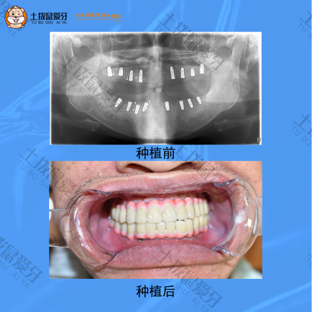 上下颌牙齿全部缺失，全口种植案例