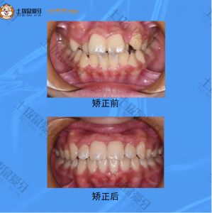 13岁，牙齿拥挤不齐矫正案例